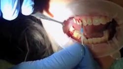 A screenshot from 'A better way to control gum disease and decay - Demonstration, part 1' showing the amount of bleeding experienced by a patient who was already brushing and flossing A screenshot from 'A better way to control gum disease and decay - Demonstration, part 1' showing the amount of bleeding experienced by a patient who was already brushing and flossing