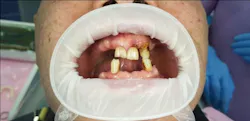 5 questions to ask before choosing between delayed and immediate dental ...