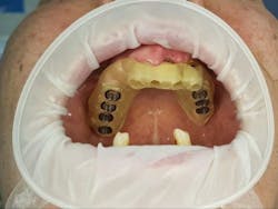 Figure 2: The first surgical guide placed in the mouth before surgery Figure 2: The first surgical guide placed in the mouth before surgery
