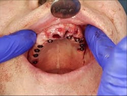 Figure 3: All of the implants placed with multiunits connected to them Figure 3: All of the implants placed with multiunits connected to them