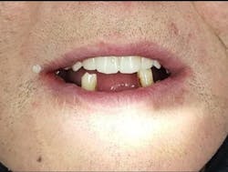 Figure 5: Vertical dimension and occlusion after the end of the procedure Figure 5: Vertical dimension and occlusion after the end of the procedure