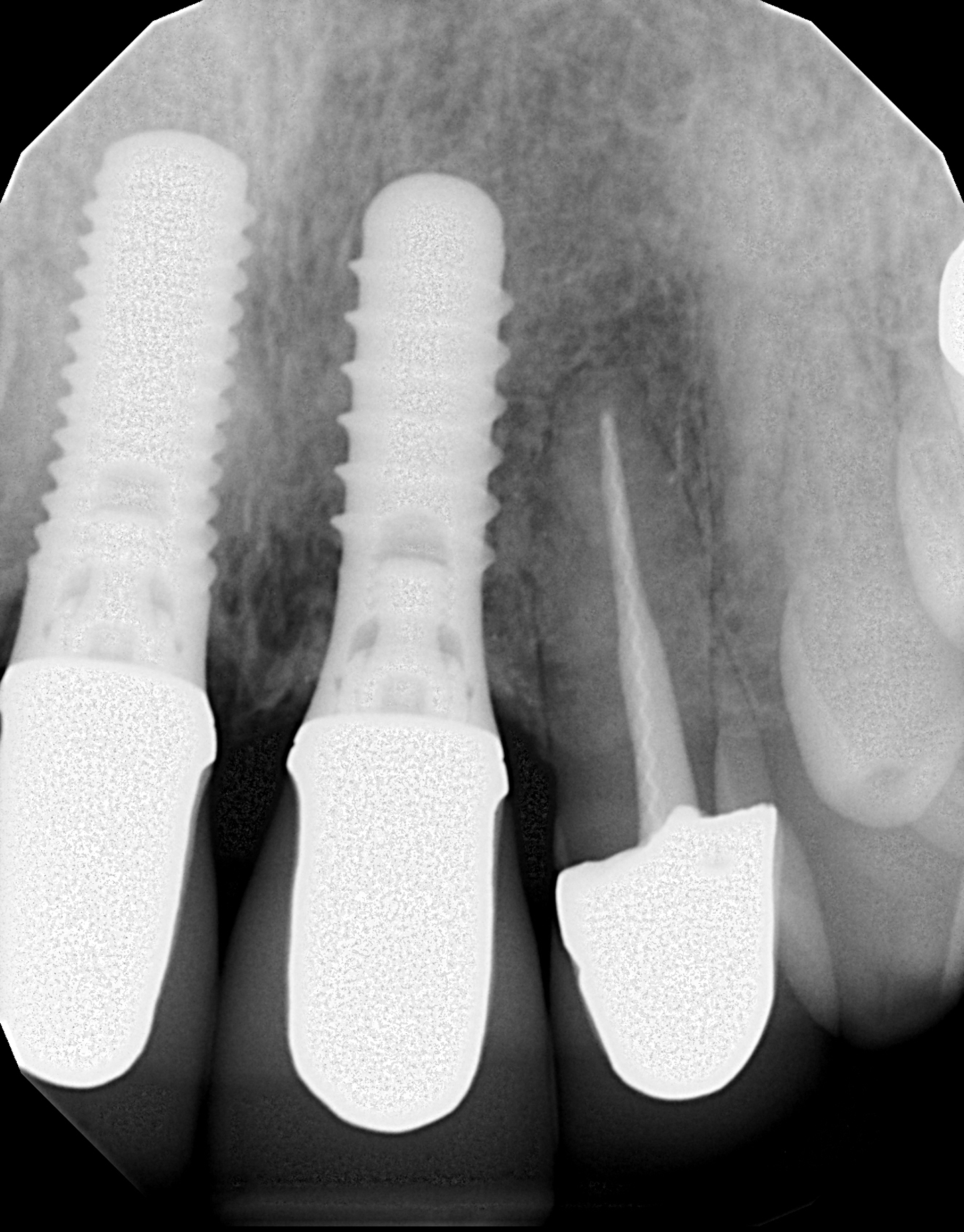 When the screws come loose in cementretained dental implant crowns