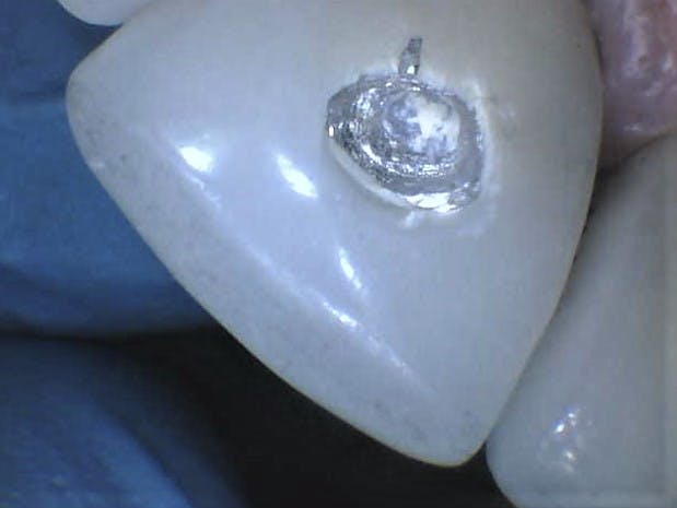 Figure 2: Access into crowns 8 and 9 with screw exposure
