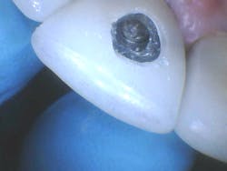 Figure 3: Access into crowns 8 and 9 with screw exposure Figure 3: Access into crowns 8 and 9 with screw exposure