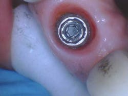 Figure 4: Soft tissue assessment after crown removal Figure 4: Soft tissue assessment after crown removal