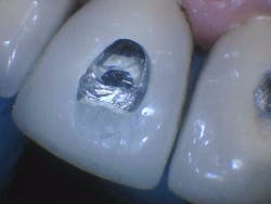 Figure 5: Access into crowns 8 and 9 with screw exposure Figure 5: Access into crowns 8 and 9 with screw exposure