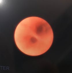 Figure 4: Laser sialolithotripsy to break up sialoliths. Photo from Joseph C. Sniezek, MD. Used with permission. Figure 4: Laser sialolithotripsy to break up sialoliths. Photo from Joseph C. Sniezek, MD. Used with permission.