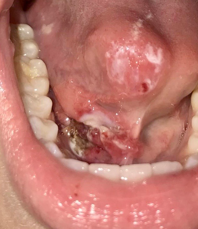 papilloma of wharton s duct que es papilomatosis acantosis