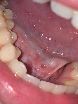 Figure 6: Healing at one-year follow-up appointment Figure 6: Healing at one-year follow-up appointment