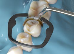 New restorative instruments, such as the Akro-Flex by Hu-Friedy, allow clinicians to take advantage of the latest advancements in restorative materials. New restorative instruments, such as the Akro-Flex by Hu-Friedy, allow clinicians to take advantage of the latest advancements in restorative materials.