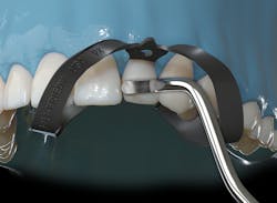 Hu Friedy Akro Flex Akro Flex Clinical Illustration 2 1911 Hu Friedy Akro Flex Akro Flex Clinical Illustration 2 1911