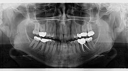 Figure 1: Panoramic radiograph of the radiopaque lesions