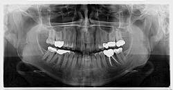 Figure 1: Panoramic radiograph of the radiopaque lesions Figure 1: Panoramic radiograph of the radiopaque lesions
