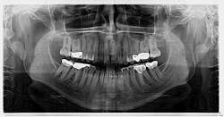 Figure 2: Panoramic radiograph taken six years prior Figure 2: Panoramic radiograph taken six years prior