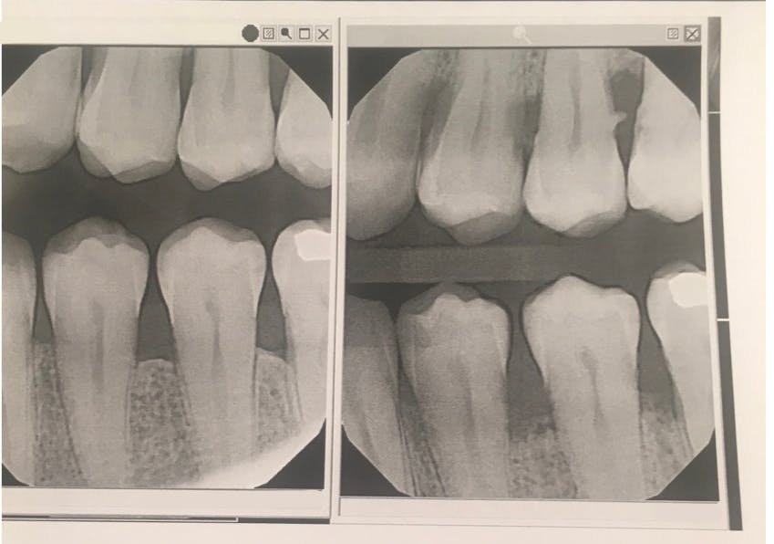 This patient showed significant improvement (left) from his original condition (right) after use of the Swedish Wonder and SRP.