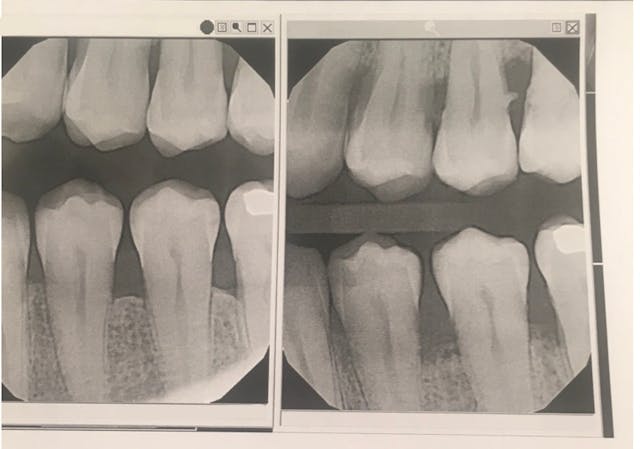 This patient showed significant improvement (left) from his original condition (right) after use of the Swedish Wonder and SRP.