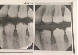 This patient showed significant improvement (left) from his original condition (right) after use of the Swedish Wonder and SRP. This patient showed significant improvement (left) from his original condition (right) after use of the Swedish Wonder and SRP.