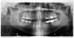 Figure 1: At presentation, the distal aspect of tooth no. 31 shows significant bone loss. Figure 1: At presentation, the distal aspect of tooth no. 31 shows significant bone loss.