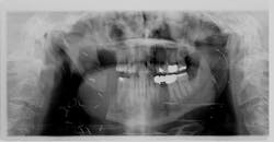 Figure 2: The previously resected area is now fully displaced, with musculature causing rapid changes in rotation. Figure 2: The previously resected area is now fully displaced, with musculature causing rapid changes in rotation.