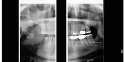 Figure 3: Successful surgery shows the absence of the fistula and no ulcerated lesions. Figure 3: Successful surgery shows the absence of the fistula and no ulcerated lesions.