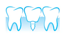 Copyright Polina Elyutina Dreamstime Implant Illustration