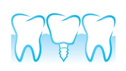 Copyright Polina Elyutina Dreamstime Implant Illustration 5f209538c5465 Copyright Polina Elyutina Dreamstime Implant Illustration 5f209538c5465