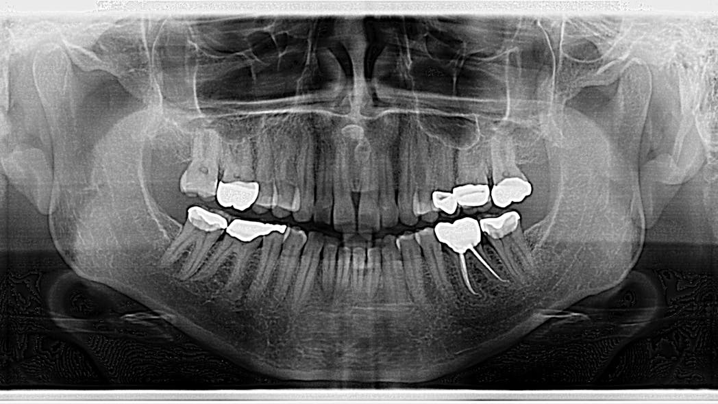 Oral pathology case The common but radiopacity