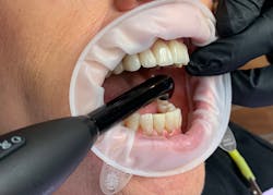 Figure 1: Nonreflective environment: OptraGate (Ivoclar Vivadent), black gloves, and black probe light. Figure 1: Nonreflective environment: OptraGate (Ivoclar Vivadent), black gloves, and black probe light.