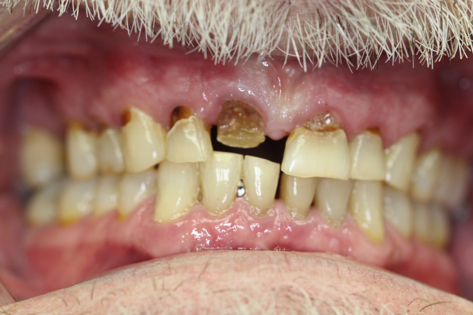 Drug Induced Dry Mouth Causes And Treatments Dentistry IQ   FIG 1.5f1209d6658d0 