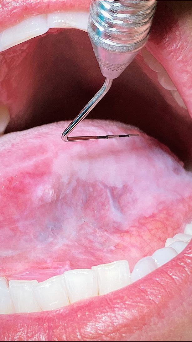 oral thrush tongue treatment