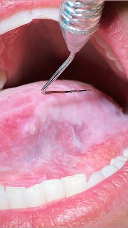Figure 1: Irregular-bordered, white lesion on the left lateral side of the tongue.
