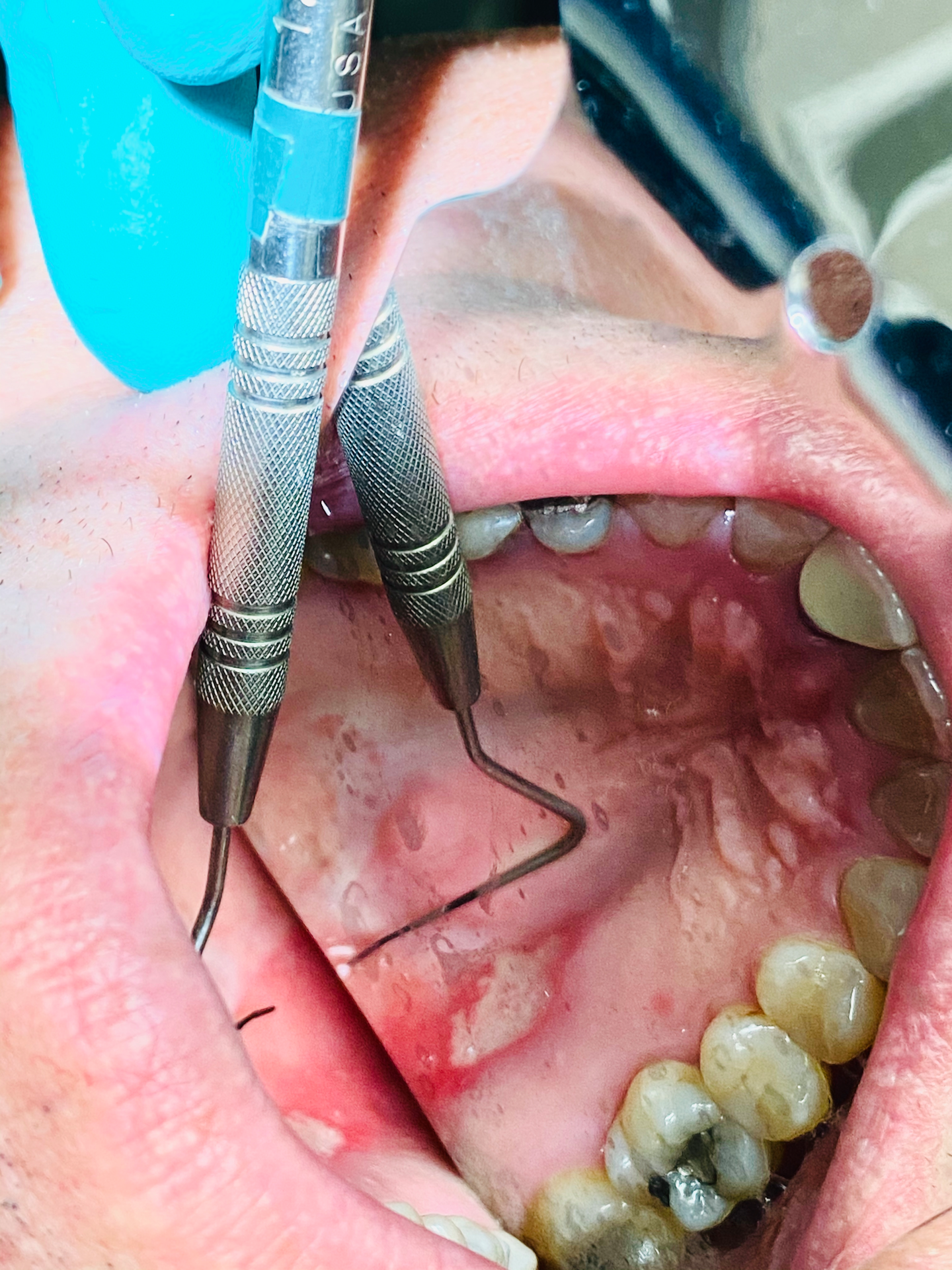 Oral Pathology Case Oral Lesion Manifestations That You Can Blame On Covid 19 Dentistryiq