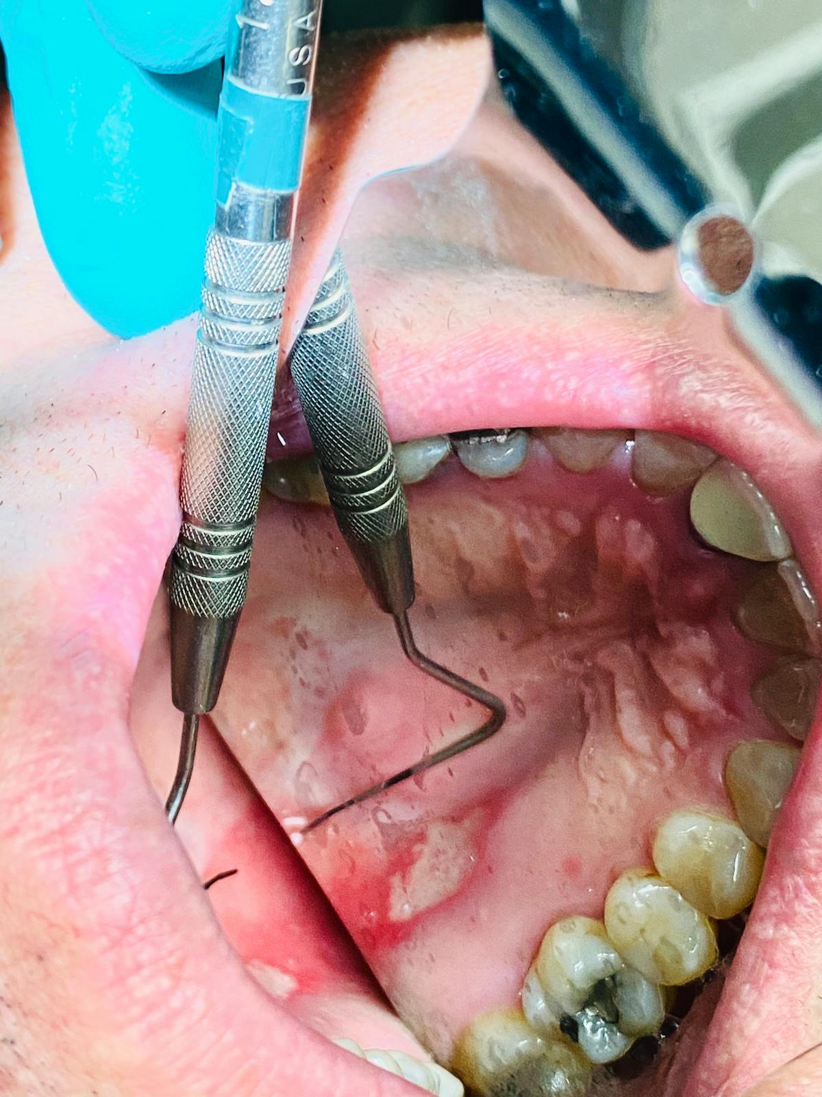 Figure 1: Patient&apos;s oral lesion.
