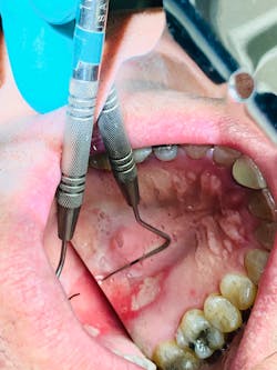 Figure 1: Patient&apos;s oral lesion.