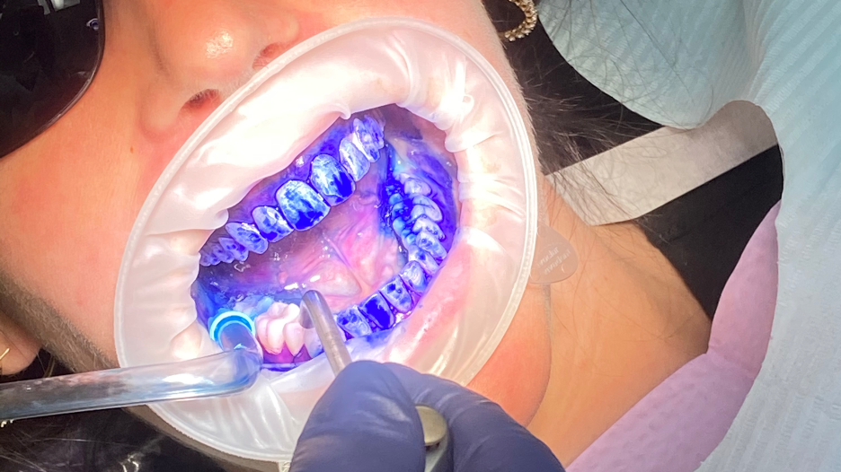 Figure 1: Apply TriPlaque ID to all tooth surfaces and rinse. Using an OptraGate (Ivoclar Vivadent) will help to retract the patient&rsquo;s lips and provide better visualization for the dental hygienist or dentist.