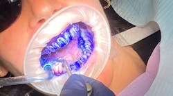 Figure 1: Apply TriPlaque ID to all tooth surfaces and rinse. Using an OptraGate (Ivoclar Vivadent) will help to retract the patient’s lips and provide better visualization for the dental hygienist or dentist. Figure 1: Apply TriPlaque ID to all tooth surfaces and rinse. Using an OptraGate (Ivoclar Vivadent) will help to retract the patient’s lips and provide better visualization for the dental hygienist or dentist.