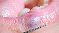 Figure2venousbluelakemole 5f6a3b7c0eff4 Figure2venousbluelakemole 5f6a3b7c0eff4