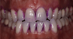Figure 2: After rinsing TriPlaque ID, identify the type of plaque present. This image shows purple and pink plaque, indicating that improved interdental plaque removal is needed.