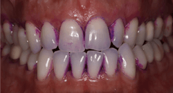 Figure 2: After rinsing TriPlaque ID, identify the type of plaque present. This image shows purple and pink plaque, indicating that improved interdental plaque removal is needed. Figure 2: After rinsing TriPlaque ID, identify the type of plaque present. This image shows purple and pink plaque, indicating that improved interdental plaque removal is needed.