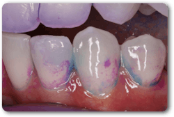 Figure 3: The presence of light blue plaque indicates a biofilm with a pH of 4.5 or less. This is important information for the dental professional for caries risk assessment and to prompt the recommendation of products that will encourage a neutral or slightly basic oral pH. Figure 3: The presence of light blue plaque indicates a biofilm with a pH of 4.5 or less. This is important information for the dental professional for caries risk assessment and to prompt the recommendation of products that will encourage a neutral or slightly basic oral pH.