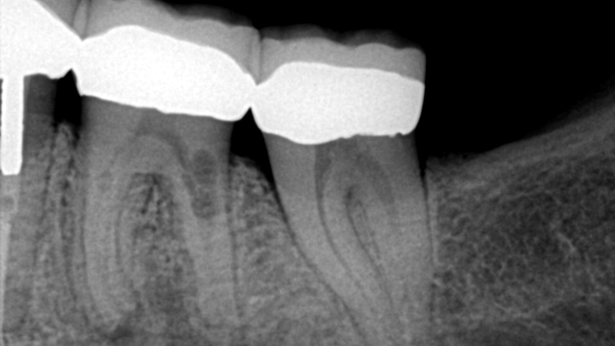 Dental resorption The silent killer Dentistry IQ