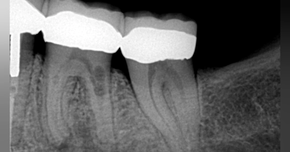 Dental resorption: The silent killer | Dentistry IQ