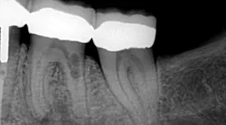 Fig4 Rainwater Internal Resorption