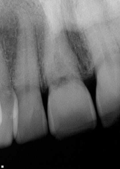 Internal resorption