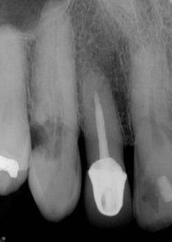 External resorption External resorption