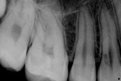 External resorption External resorption