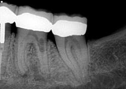 Internal resorption Internal resorption