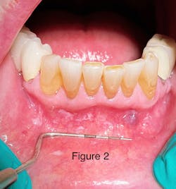 Figure 2: Area after white patches were wiped off with gauze Figure 2: Area after white patches were wiped off with gauze