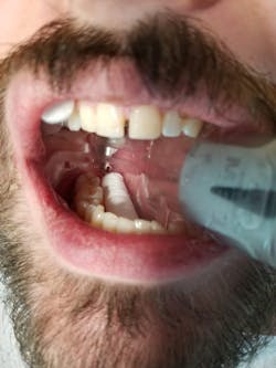 Place a cotton roll on the floor of the mouth or upper vestibule area to get 100% isolation. Place a cotton roll on the floor of the mouth or upper vestibule area to get 100% isolation.