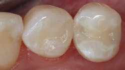 Figure2 Post Op Venus Pearl Venus Diamond 5fbbf0420aa15 Figure2 Post Op Venus Pearl Venus Diamond 5fbbf0420aa15